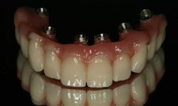 Dental Implants « Brånemark Center